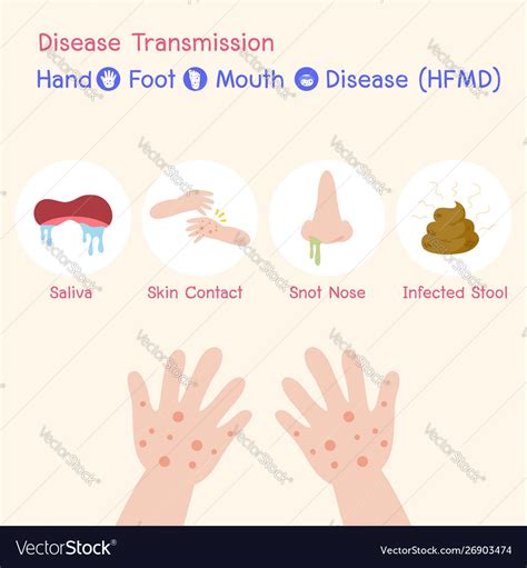 Hand Foot And Mouth Disease Hfmd Medical Vector Image