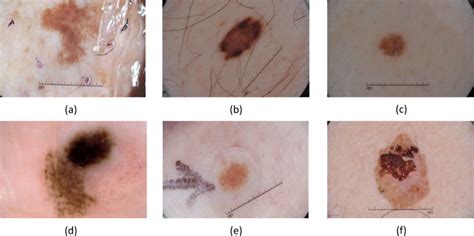 Samples of different classes of dermoscopy images. From left to right ...