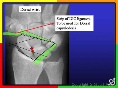 Scapholunate Ligament Repair And Dorsal Capsulodesis