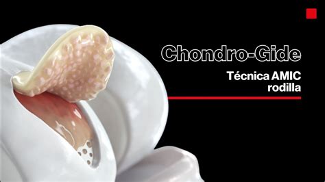 Amic Chondro Gide® Reparación De Cartílago En La Rodilla Youtube