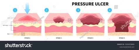 Pressure Ulcer: Over 286 Royalty-Free Licensable Stock Illustrations ...