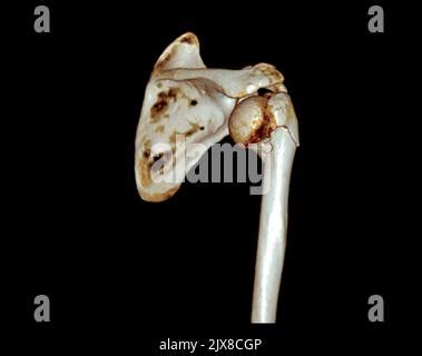 Computed Tomography Volume Rendering Examination Of The Shoulder D