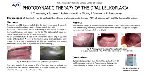 PDF Photodynamic Therapy Of The Oral Leukoplakia