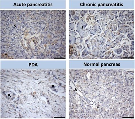 Stellate Cell Activation In Various Pathologies Of The Human Pancreas