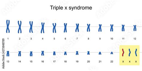 Triple x syndrome karyotype vector ESP10 Stock Vector | Adobe Stock 