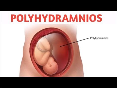 Polyhydramnios Polyhydramnios Pregnancy Amniotic Fluid Youtube