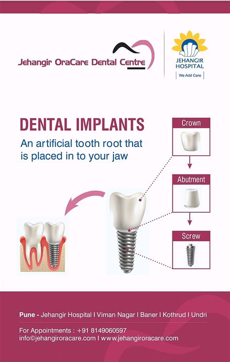 Cost Of Dental Implant In Pune India