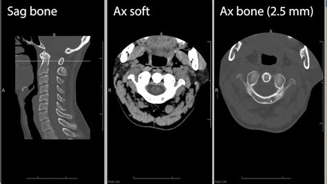 Cervical Spine Ct Scan