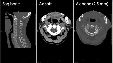 Cervical Spine Ct Computed Tomography Radiology Search Pattern Youtube