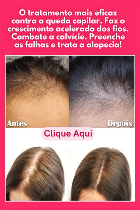 O Tratamento Mais Eficaz Contra A Queda Capilar Alop Cia Cabelo