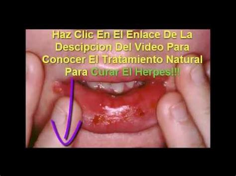 Como Eliminar El Herpes Labial Rapido Y Facil Youtube