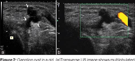 Figure From Ultrasound And Doppler Us In Evaluation Of Superficial