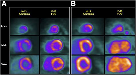 Joint Snmmiasnc Expert Consensus Document On The Role Of 18f Fdg Pet