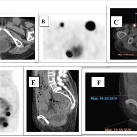 A 66 Year Old Female Patient With A History Of Rectal Carcinoma