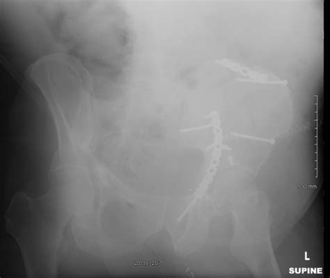 Immediate Postoperative Ap And Oblique Pelvic Radiographs Demonstrating