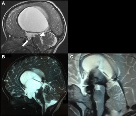 Hydrocephalus Due To Aqueductal Stenosis A Sagittal T2 Weighted Image Download Scientific