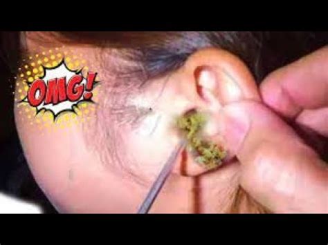 Huge Ear Wax Removal Massive Removal Of Earwax 2020 YouTube