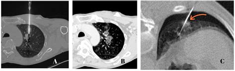 Jcm Free Full Text Safe Zone To Avoid Pneumothorax In A Ct Guided