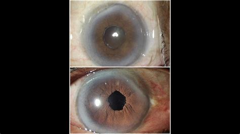 Small Pupil And Hard Cataract YouTube