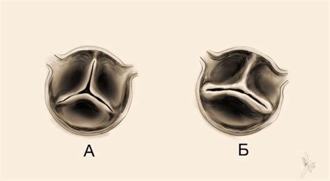 Аортальный тон изгнания и двустворчатый аортальный клапан Стетоскоп
