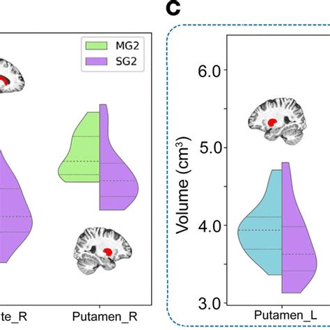 Subcortical Nuclei With Significant Volumetric Differences Between