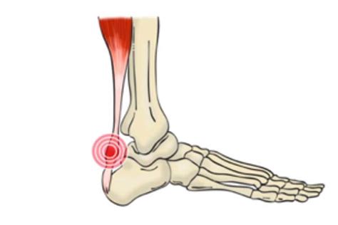 Tendinitis De Aquiles Qu Es Y C Mo Se Trata Fisiolution