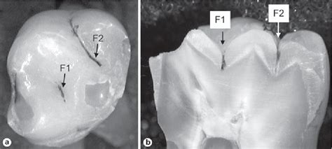 Table 1 From Diagnosis Of Pit And Fissure Caries Using Frequency Domain