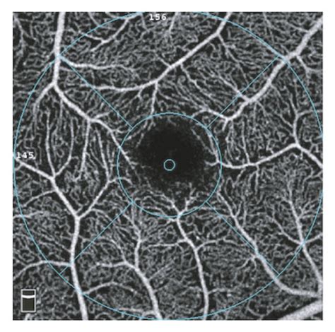 Measurement Of Optical Coherence Tomography Angiography Parameters On A Download Scientific