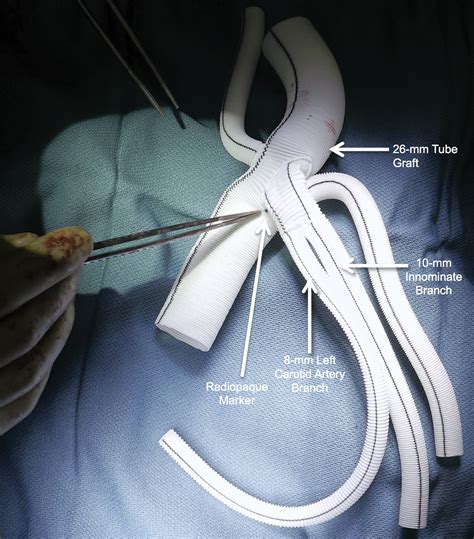 Zone Arch Replacement And Staged Thoracic Endovascular Aortic Repair