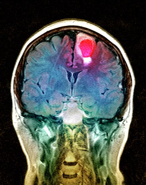 Brain Tumour Photograph By Simon Fraserscience Photo Library