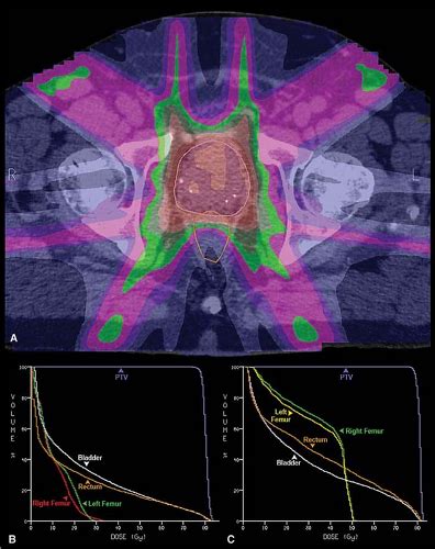 Cancers Of The Genitourinary Tract Oncohema Key