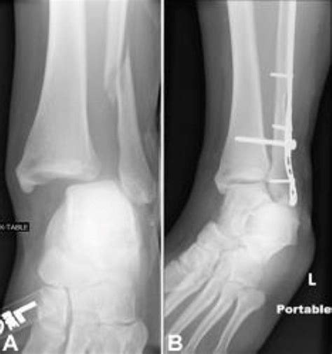 Trimalleolar Ankle Fracture Recovery