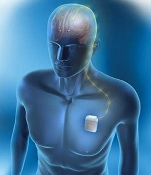 Medtronic Deep Brain Stimulation Devices Multiple Models