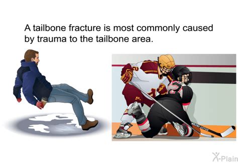 PatEdu.com : Tailbone Fracture