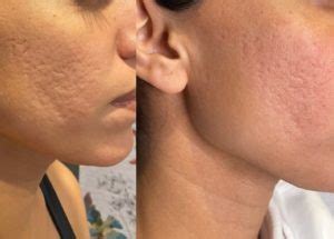 Acne Scar Treatment Serving Vancouver Surrey Burnaby