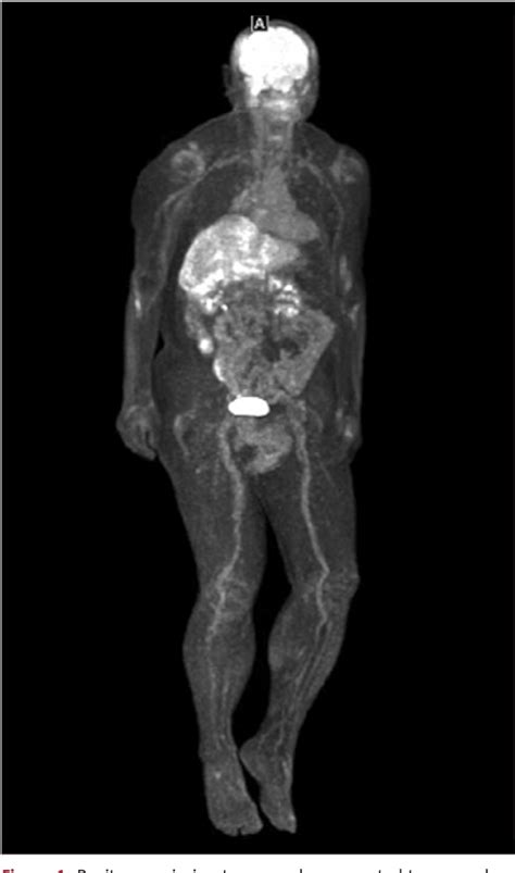 Figure From Abdominal Tuberculosis Mimicking Cancer Clinically And On