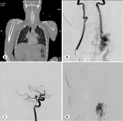 Figure 1 From Vertebrojugular Arteriovenous Fistula And Pseudoaneurysm Formation Due To