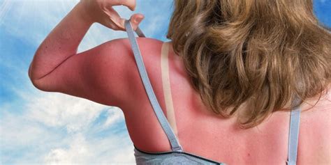 Sun Poisoning Symptoms Treatment And Prevention