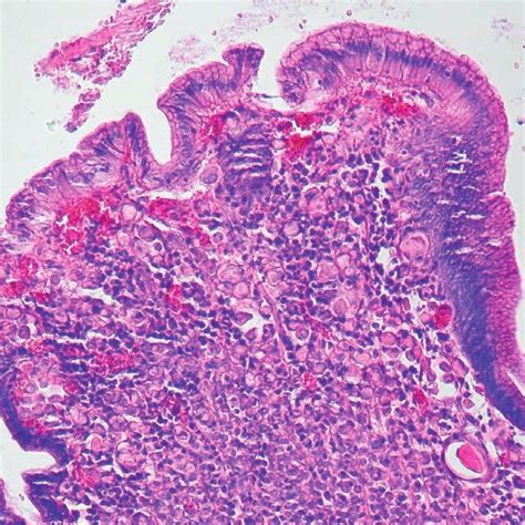 Histological Examination Of Biopsy From The Stomach Coarse Mucosa That