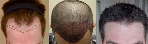 Hairline Lowering Temple Recession Enhancement Alvi Armani Hair