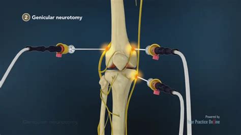 Nerve Block For Knee Arthroscopy