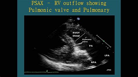 Normal Views Transthoracic Echocardiogram Tte Youtube