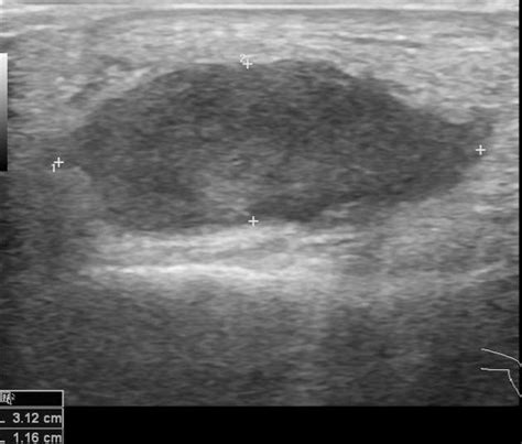 Subcutaneous Hematoma Distal Leg Radiology Case 57 OFF