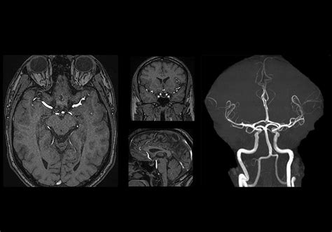 Time-of-Flight (TOF) MR Angiography of the brain