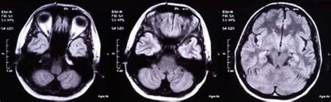 Ostre rozsiane zapalenie mózgu i rdzenia ADEM Neurologia Praktyczna