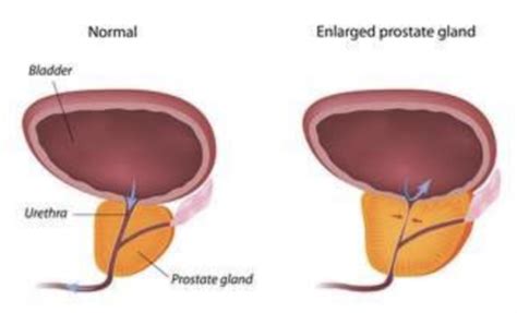 Health Assessment Lecture Anus Rectum Prostate Flashcards Quizlet