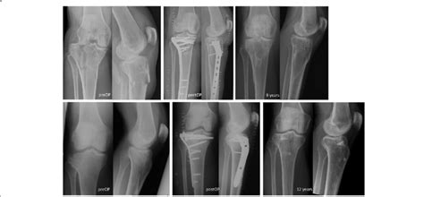 Radiographs Showing Preoperative Postoperative And Long Term