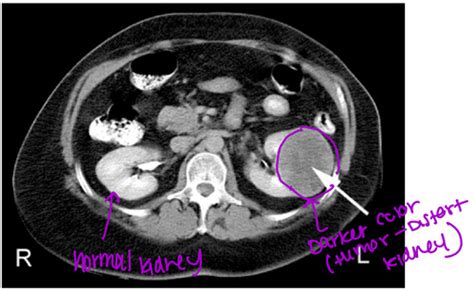 Urology And Renal Questions Flashcards Quizlet