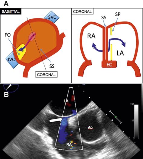 Imaging Of Atrial Septal Defects Echocardiography And Ct Correlation Heart