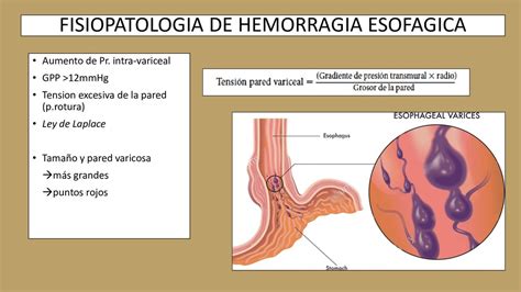 Varices Esof Gicas Speaker Deck